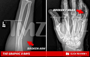 Floyd 'Money' Mayweather Jr's accuser's broken bones images - x rays.